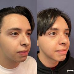 Rinoplastia - Dr. Sergio Guillermo Ramírez Ledesma