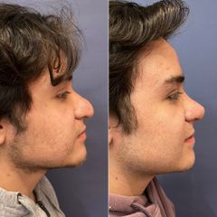 Rinoplastia - Dr. Sergio Guillermo Ramírez Ledesma