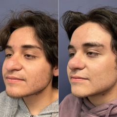 Rinoplastia - Dr. Sergio Guillermo Ramírez Ledesma