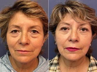 Blefaroplastia antes y después - 875864