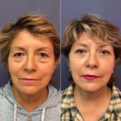 Blefaroplastia - Dr. Sergio Guillermo Ramírez Ledesma