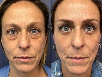 Blefaroplastia antes y después - 876129