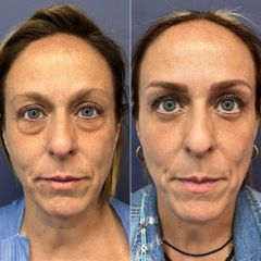 Blefaroplastia - Dr. Sergio Guillermo Ramírez Ledesma