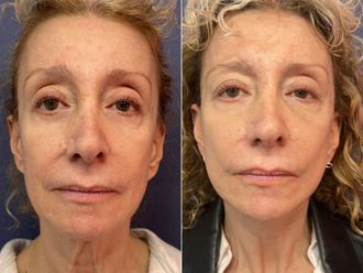 Rejuvenecimiento facial antes y después - 876134