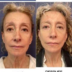 Rejuvenecimiento facial - Dr. Sergio Guillermo Ramírez Ledesma