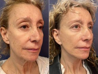 Rejuvenecimiento facial antes y después - 876135