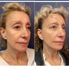 Rejuvenecimiento facial - Dr. Sergio Guillermo Ramírez Ledesma