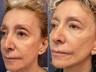 Rejuvenecimiento facial antes y después - 876136