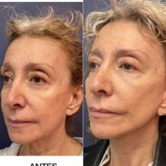 Rejuvenecimiento facial - Dr. Sergio Guillermo Ramírez Ledesma