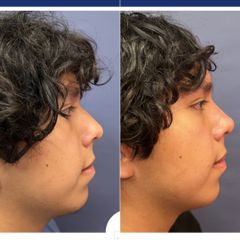 Rinoplastia - Dr. Sergio Guillermo Ramírez Ledesma