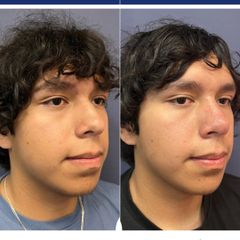 Rinoplastia - Dr. Sergio Guillermo Ramírez Ledesma