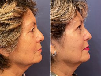 Blefaroplastia antes y después - 876139