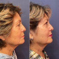 Blefaroplastia - Dr. Sergio Guillermo Ramírez Ledesma