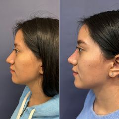 Rinoplastia - Dr. Sergio Guillermo Ramírez Ledesma