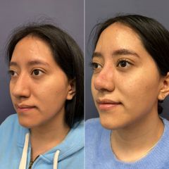 Rinoplastia - Dr. Sergio Guillermo Ramírez Ledesma