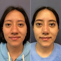 Rinoplastia - Dr. Sergio Guillermo Ramírez Ledesma