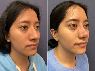 Rinoplastia antes y después - 876143