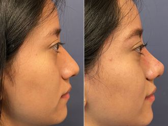 Rinoplastia antes y después - 876144