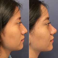 Rinoplastia - Dr. Sergio Guillermo Ramírez Ledesma