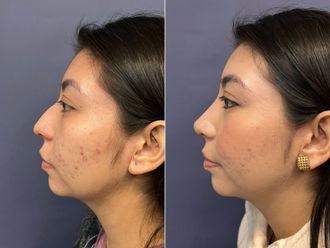 Rinoplastia antes y después - 876145
