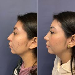 Rinoplastia - Dr. Sergio Guillermo Ramírez Ledesma