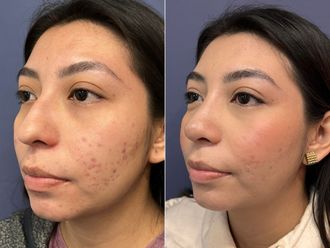 Rinoplastia antes y después - 876146