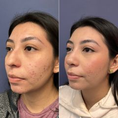 Rinoplastia - Dr. Sergio Guillermo Ramírez Ledesma