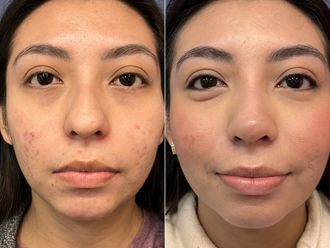 Rinoplastia antes y después - 876147