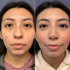 Rinoplastia - Dr. Sergio Guillermo Ramírez Ledesma
