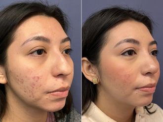 Rinoplastia antes y después - 876148