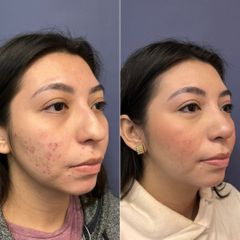 Rinoplastia - Dr. Sergio Guillermo Ramírez Ledesma