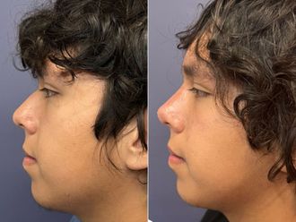 Rinoplastia antes y después - 876192