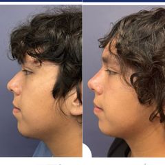 Rinoplastia - Dr. Sergio Guillermo Ramírez Ledesma