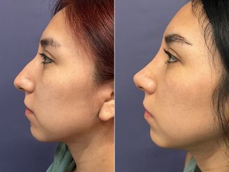 Rinoplastia antes y después - 876193