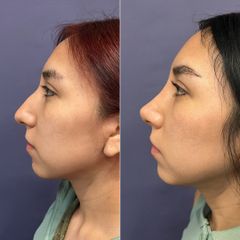 Rinoplastia - Dr. Sergio Guillermo Ramírez Ledesma