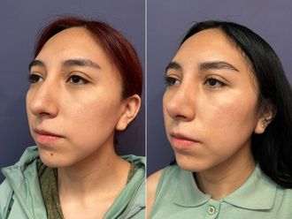 Rinoplastia antes y después - 876194