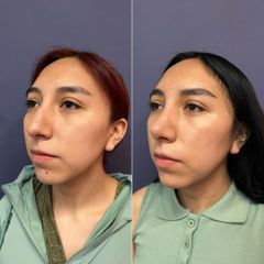 Rinoplastia - Dr. Sergio Guillermo Ramírez Ledesma