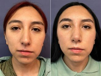 Rinoplastia antes y después - 876195