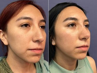Rinoplastia antes y después - 876196