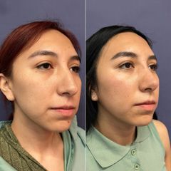 Rinoplastia - Dr. Sergio Guillermo Ramírez Ledesma