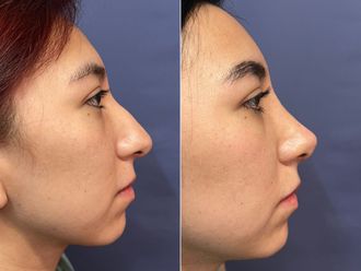 Rinoplastia antes y después - 876197