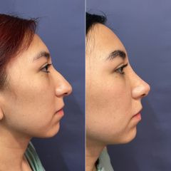 Rinoplastia - Dr. Sergio Guillermo Ramírez Ledesma