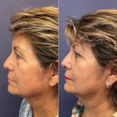 Blefaroplastia - Dr. Sergio Guillermo Ramírez Ledesma