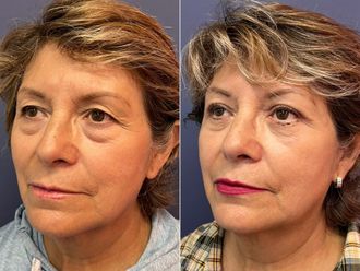 Blefaroplastia antes y después - 876199