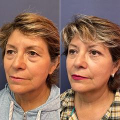 Blefaroplastia - Dr. Sergio Guillermo Ramírez Ledesma