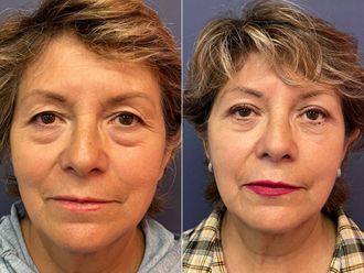 Blefaroplastia antes y después - 876200