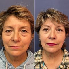 Blefaroplastia - Dr. Sergio Guillermo Ramírez Ledesma
