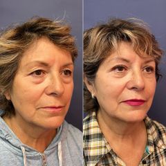 Blefaroplastia - Dr. Sergio Guillermo Ramírez Ledesma