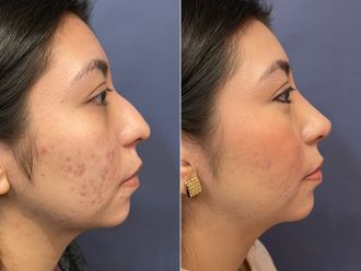 Rinoplastia antes y después - 876202
