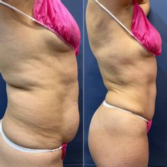 Abdominoplastía